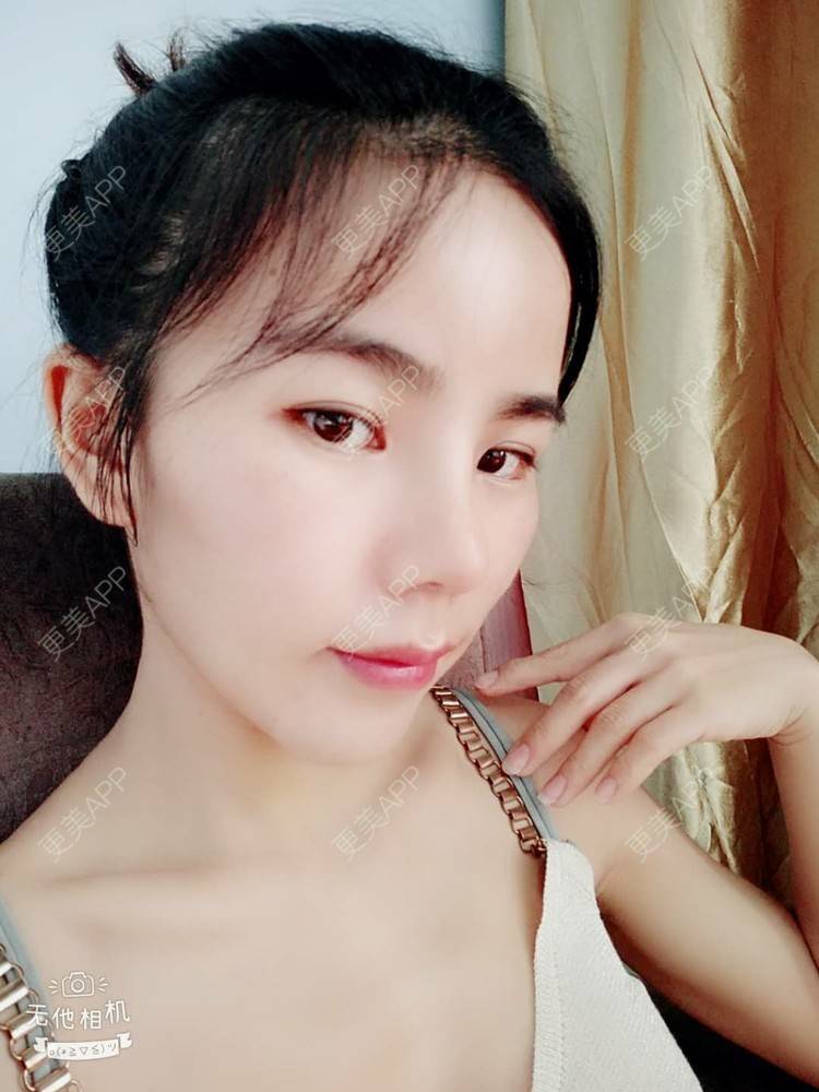 更美 - 张翎 医生的硅胶隆鼻经验 | 硅胶隆鼻 | 南宁