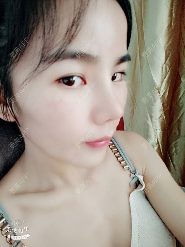更美 - 张翎 医生的硅胶隆鼻经验 | 硅胶隆鼻 | 南宁