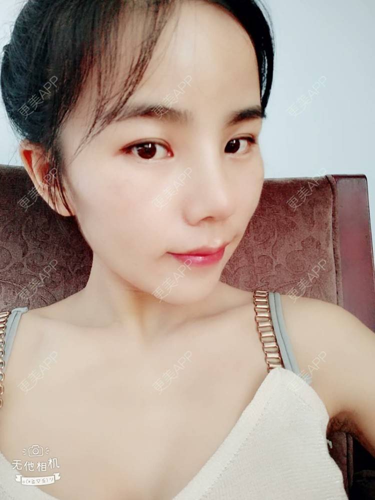 更美 - 张翎 医生的硅胶隆鼻经验 | 硅胶隆鼻 | 南宁