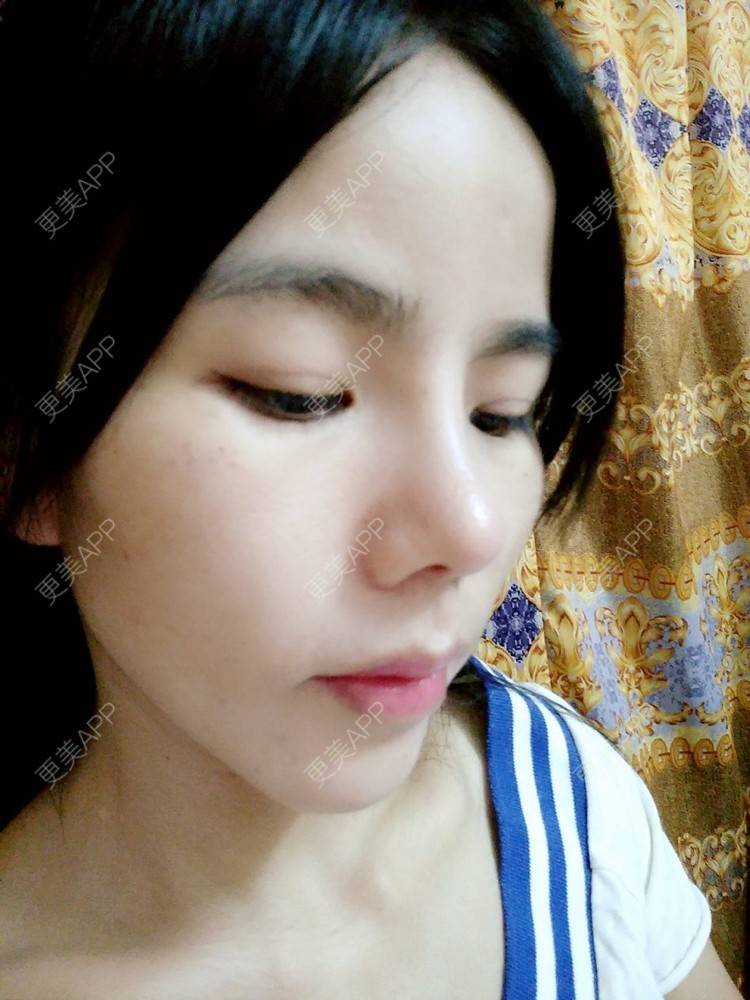 更美 - 张翎 医生的硅胶隆鼻经验 | 硅胶隆鼻 | 南宁