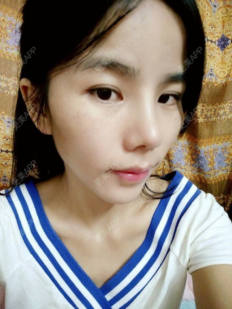 更美 - 张翎 医生的硅胶隆鼻经验 | 硅胶隆鼻 | 南宁