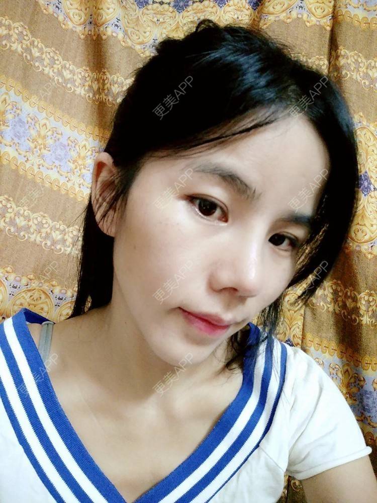 更美 - 张翎 医生的硅胶隆鼻经验 | 硅胶隆鼻 | 南宁