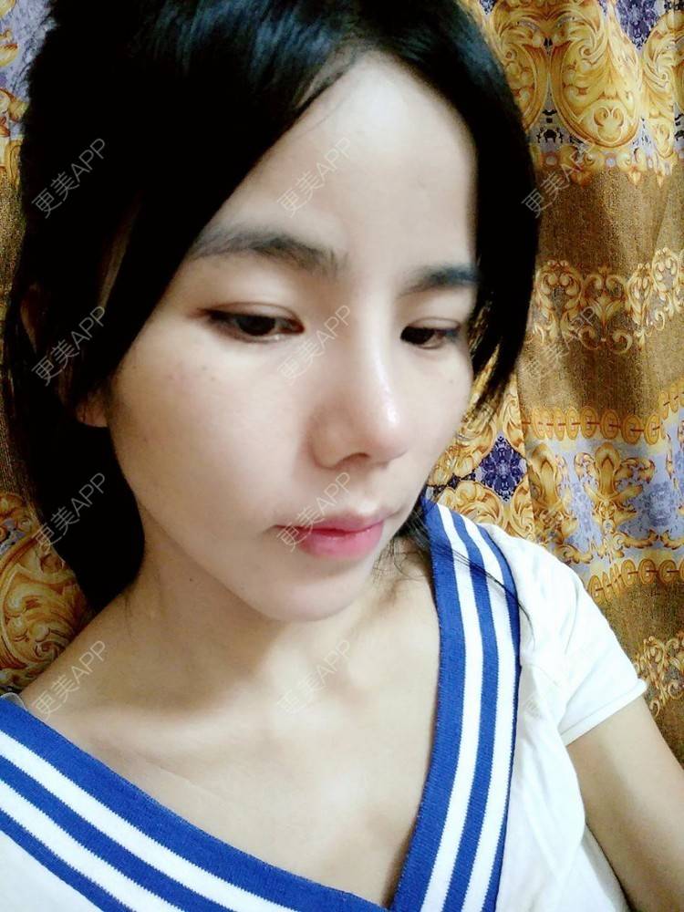 更美 - 张翎 医生的硅胶隆鼻经验 | 硅胶隆鼻 | 南宁