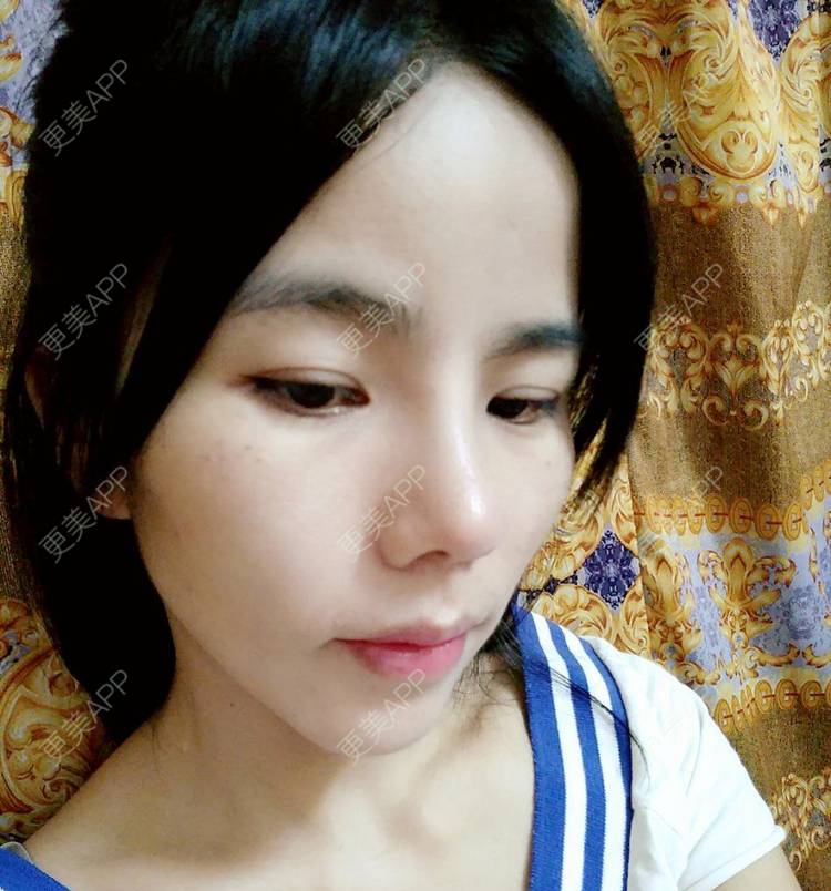更美 - 张翎 医生的硅胶隆鼻经验 | 硅胶隆鼻 | 南宁