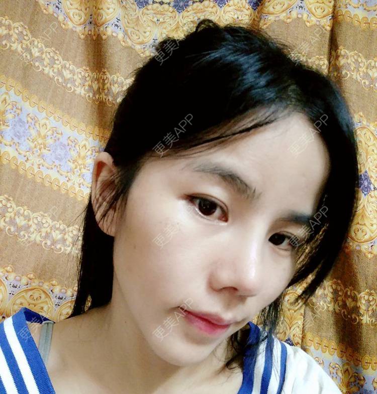 更美 - 张翎 医生的硅胶隆鼻经验 | 硅胶隆鼻 | 南宁