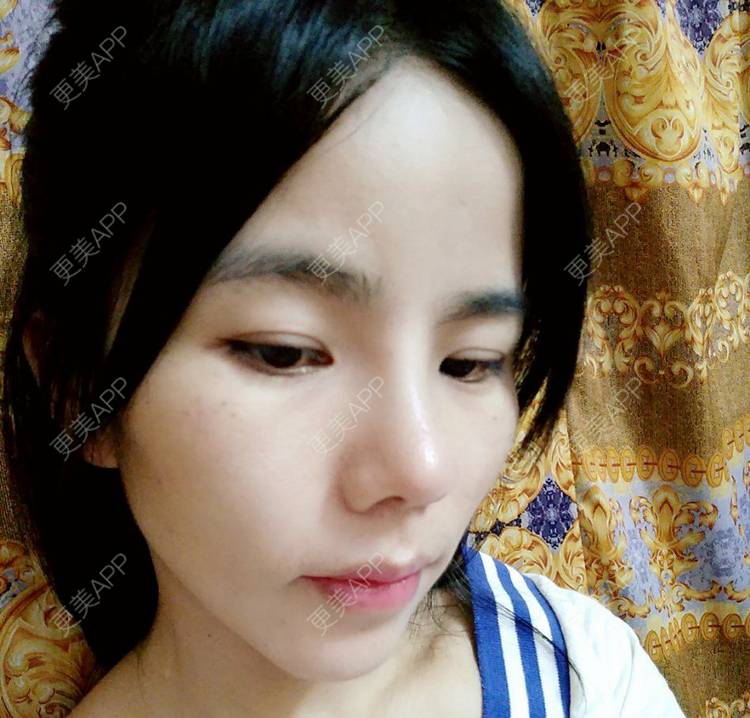 更美 - 张翎 医生的硅胶隆鼻经验 | 硅胶隆鼻 | 南宁