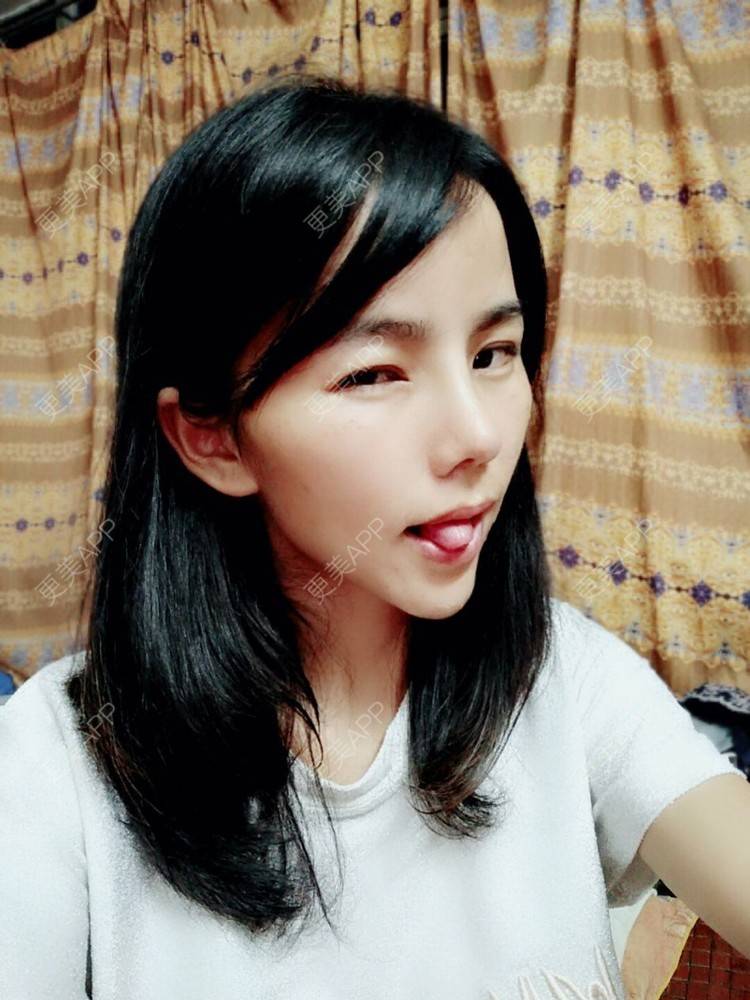 更美 - 张翎 医生的硅胶隆鼻经验 | 硅胶隆鼻 | 南宁