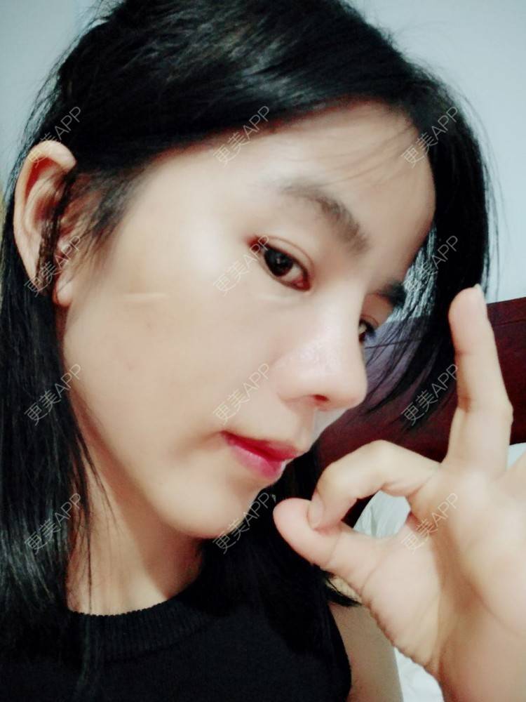 更美 - 张翎 医生的硅胶隆鼻经验 | 硅胶隆鼻 | 南宁