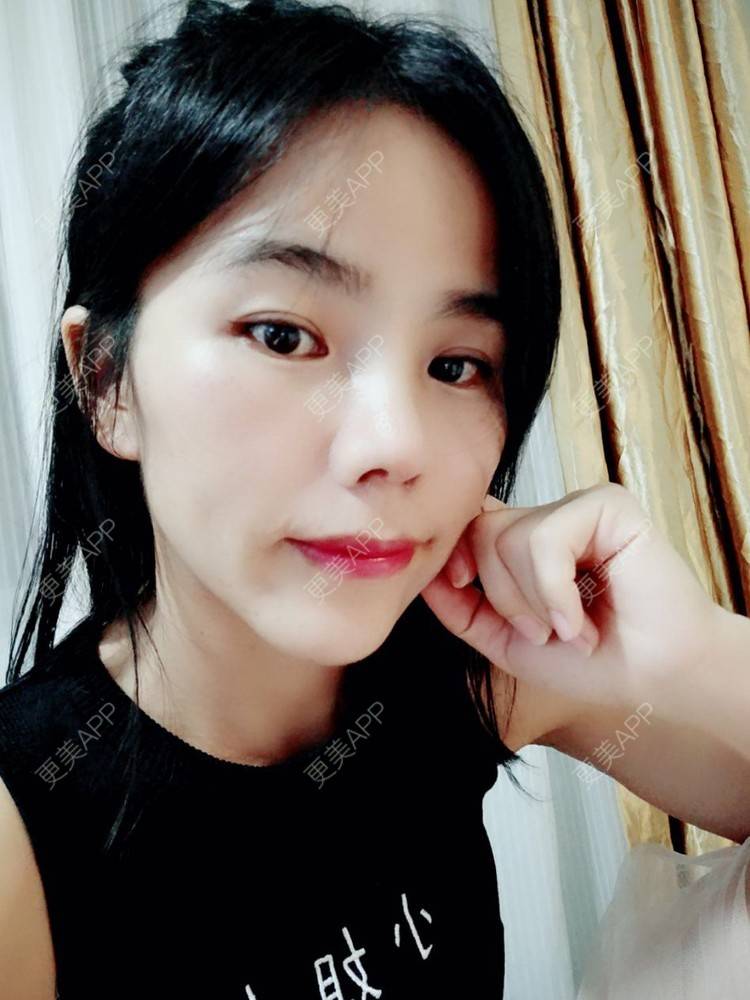 更美 - 张翎 医生的硅胶隆鼻经验 | 硅胶隆鼻 | 南宁
