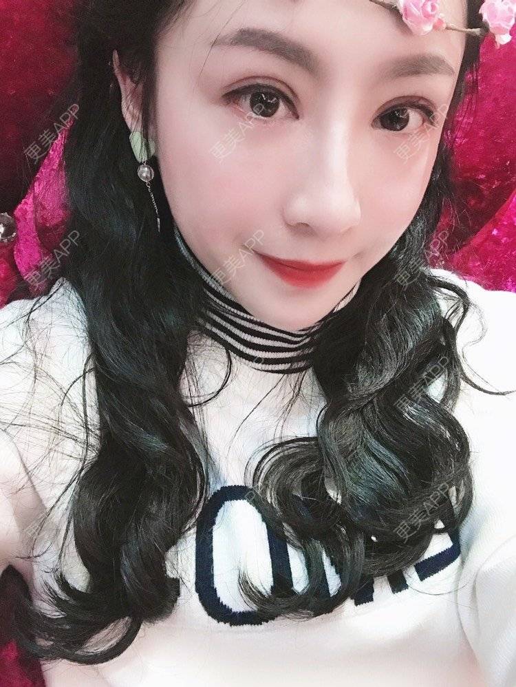 更美 - 卡门小妖精，的玻尿酸卧蚕经验 | 玻尿酸卧蚕 | 重庆 | 自体脂肪丰卧蚕 | 真皮丰卧蚕 | 双眼皮修复 | 眼部多项