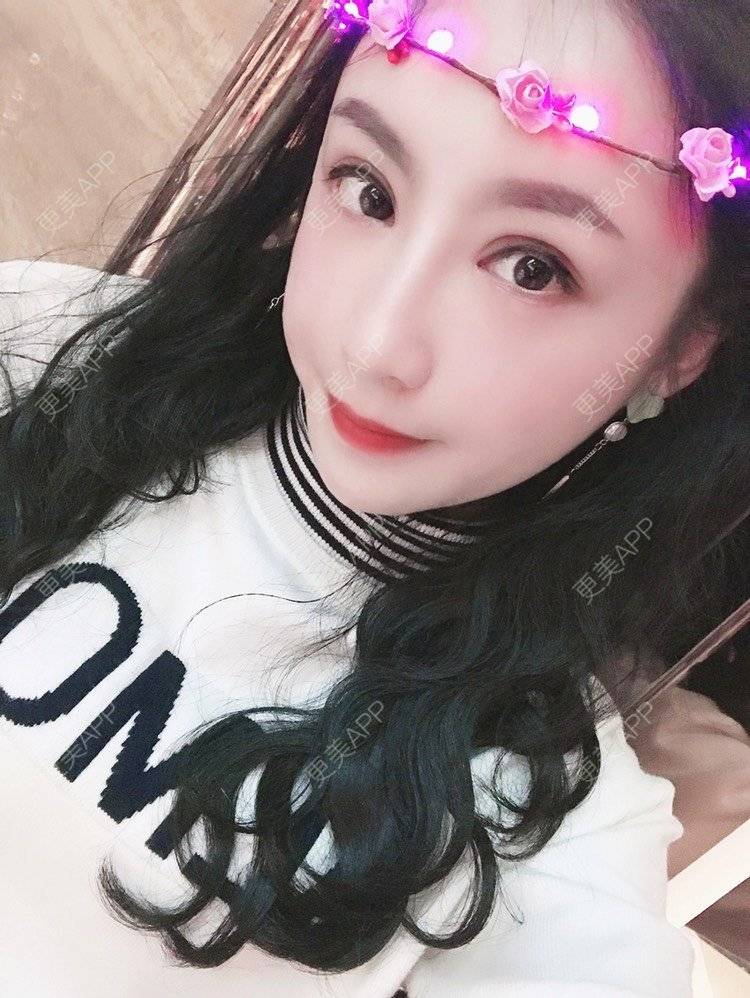 更美 - 卡门小妖精，的玻尿酸卧蚕经验 | 玻尿酸卧蚕 | 重庆 | 自体脂肪丰卧蚕 | 真皮丰卧蚕 | 双眼皮修复 | 眼部多项