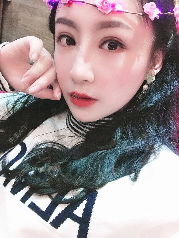 更美 - 卡门小妖精，的玻尿酸卧蚕经验 | 玻尿酸卧蚕 | 重庆 | 自体脂肪丰卧蚕 | 真皮丰卧蚕 | 双眼皮修复 | 眼部多项