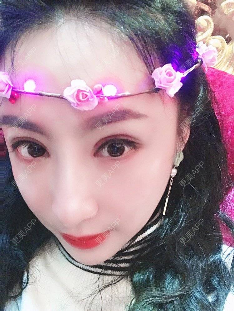 更美 - 卡门小妖精，的玻尿酸卧蚕经验 | 玻尿酸卧蚕 | 重庆 | 自体脂肪丰卧蚕 | 真皮丰卧蚕 | 双眼皮修复 | 眼部多项