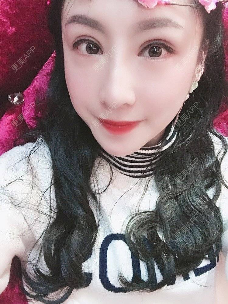 更美 - 卡门小妖精，的玻尿酸卧蚕经验 | 玻尿酸卧蚕 | 重庆 | 自体脂肪丰卧蚕 | 真皮丰卧蚕 | 双眼皮修复 | 眼部多项