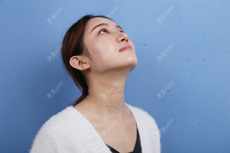 更美 - 瑶瑶就要瑶瑶的颈部经验 | 玻尿酸颈纹 | 颈部 | 广州