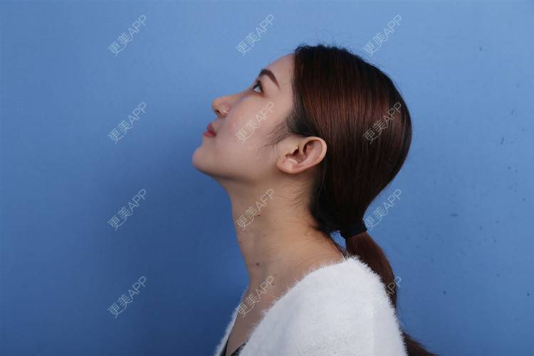 更美 - 瑶瑶就要瑶瑶的颈部经验 | 玻尿酸颈纹 | 颈部 | 广州