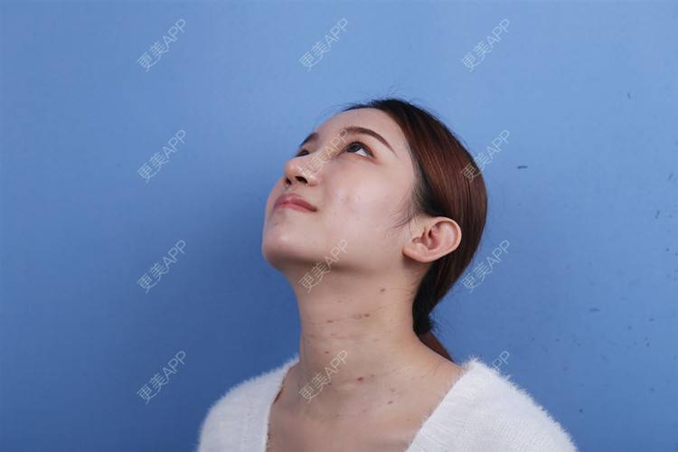 更美 - 瑶瑶就要瑶瑶的颈部经验 | 玻尿酸颈纹 | 颈部 | 广州