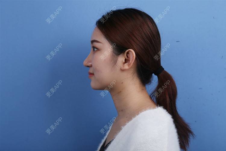 更美 - 瑶瑶就要瑶瑶的颈部经验 | 玻尿酸颈纹 | 颈部 | 广州