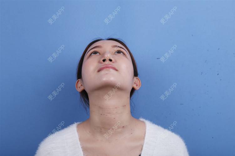 更美 - 瑶瑶就要瑶瑶的颈部经验 | 玻尿酸颈纹 | 颈部 | 广州