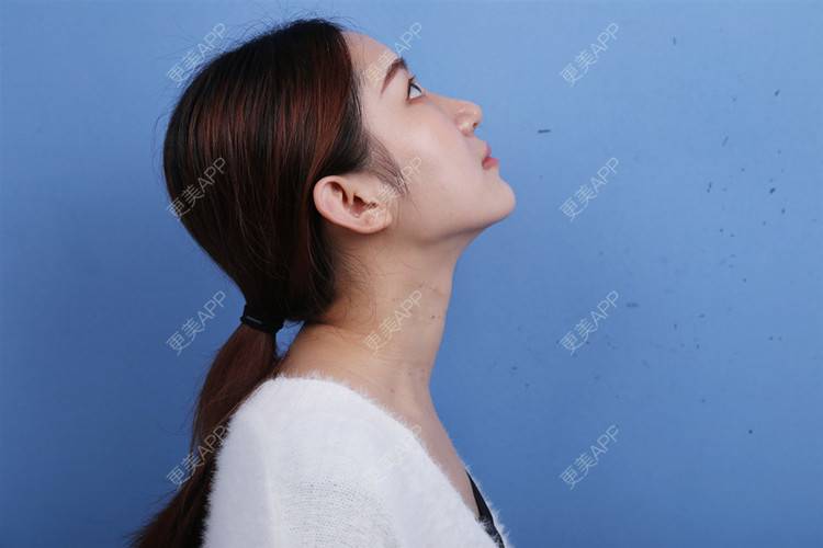 更美 - 瑶瑶就要瑶瑶的颈部经验 | 玻尿酸颈纹 | 颈部 | 广州