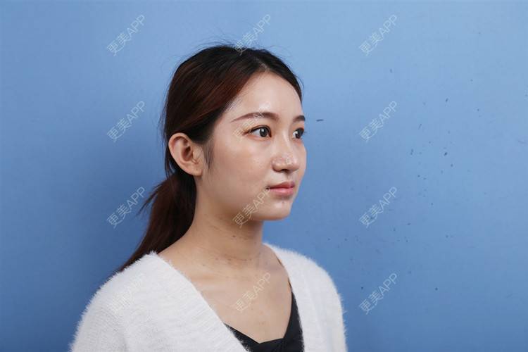 更美 - 瑶瑶就要瑶瑶的颈部经验 | 玻尿酸颈纹 | 颈部 | 广州