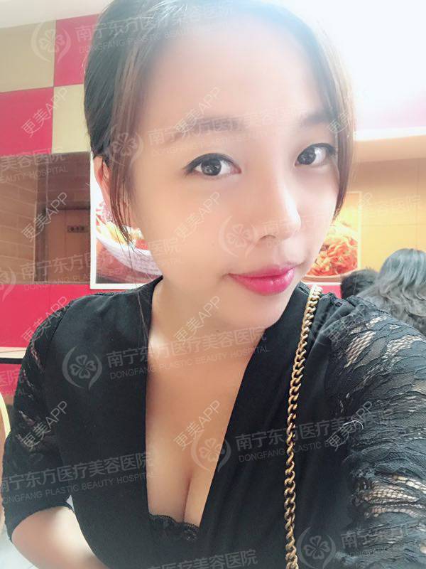 更美 - 邓晧畇 医生的假体隆胸经验 | 假体隆胸 | 南宁