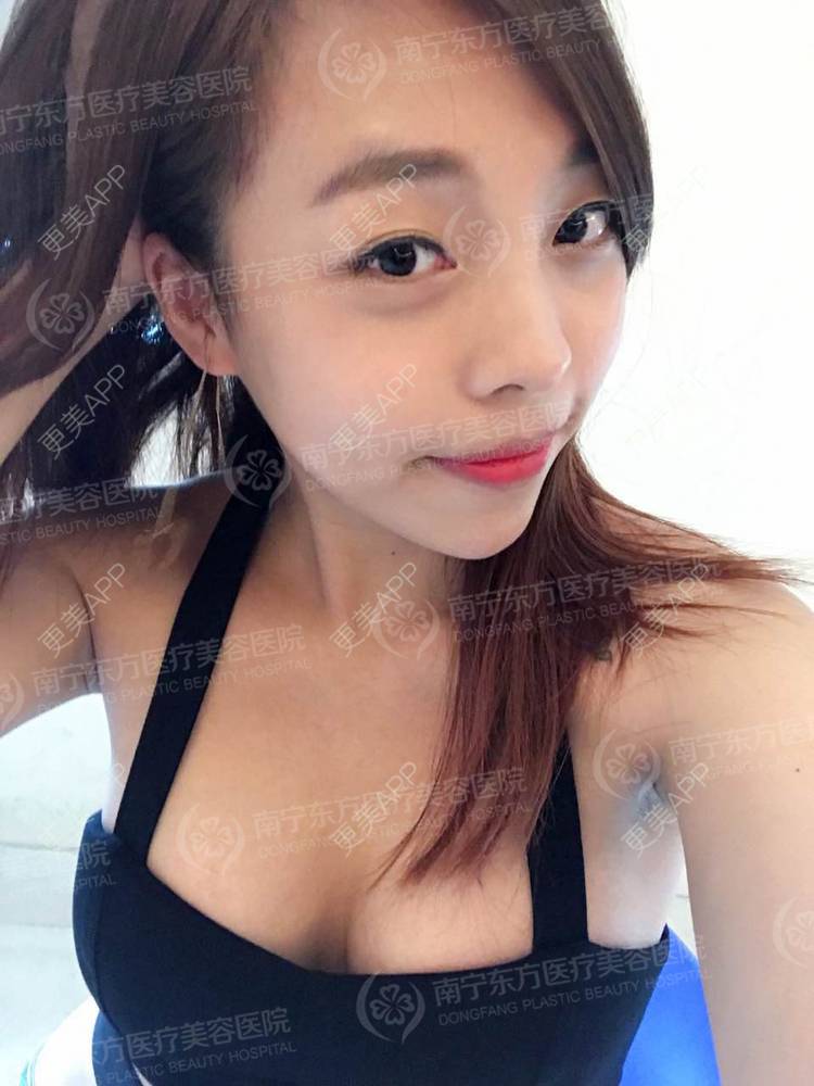更美 - 邓晧畇 医生的假体隆胸经验 | 假体隆胸 | 南宁