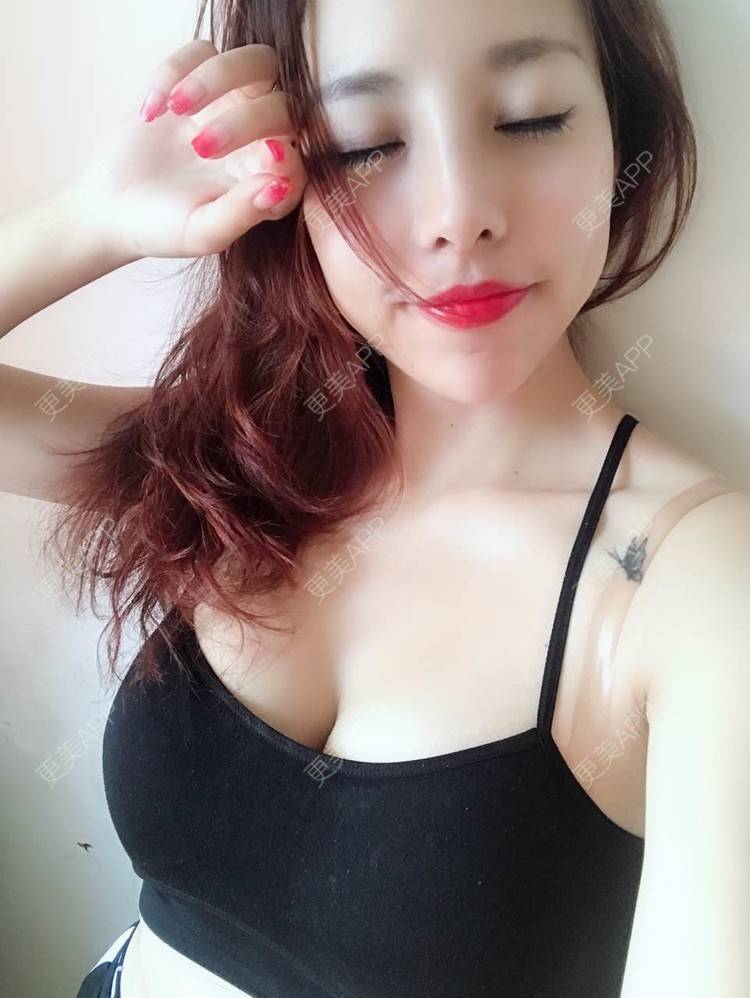 更美 - 邓晧畇 医生的假体隆胸经验 | 假体隆胸 | 南宁
