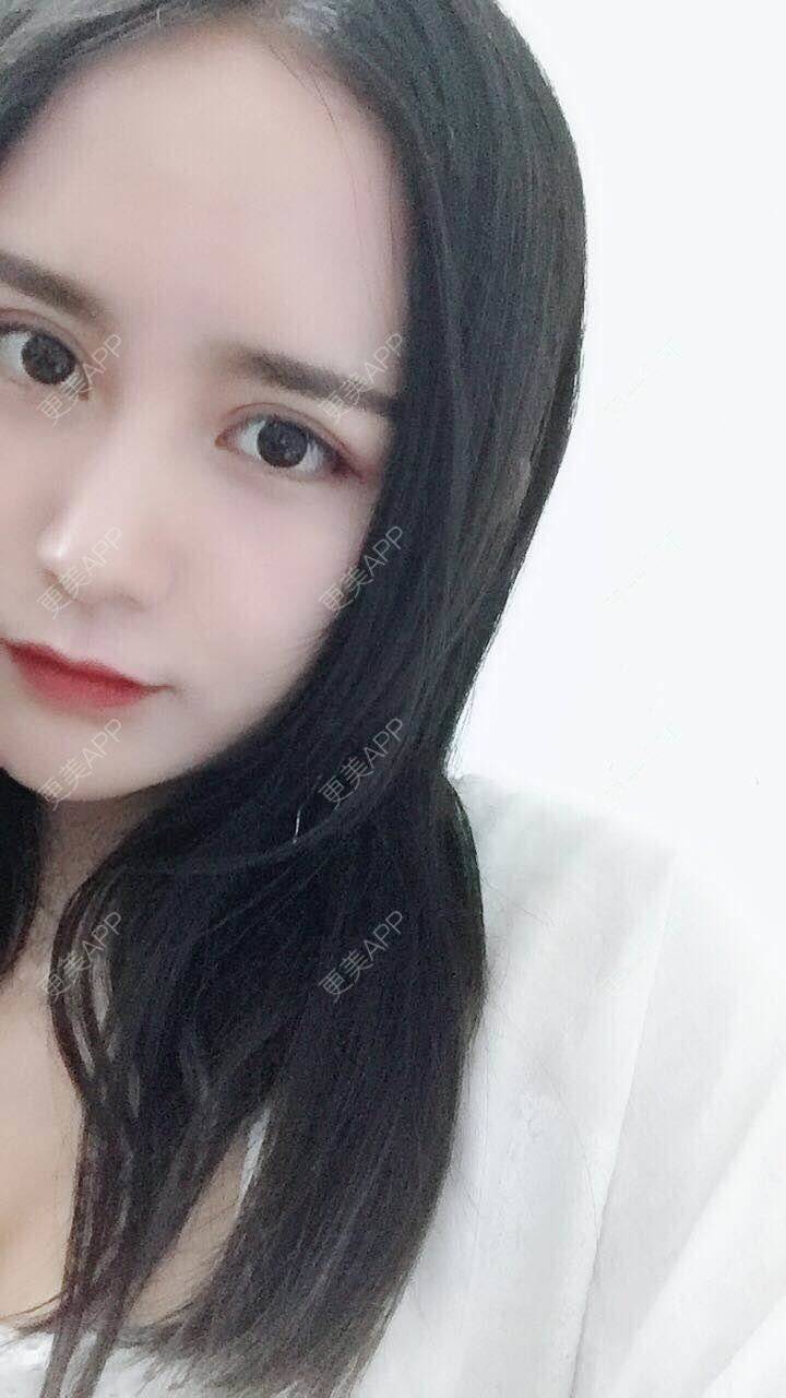 更美 - 柠木脊的吸脂瘦脸经验 | 吸脂瘦脸 | 长沙