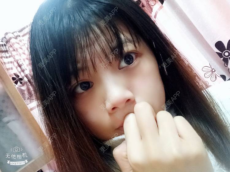 更美 - 更美用户2xAqCgwVY0的内切去眼袋经验 | 内切去眼袋 | 武汉