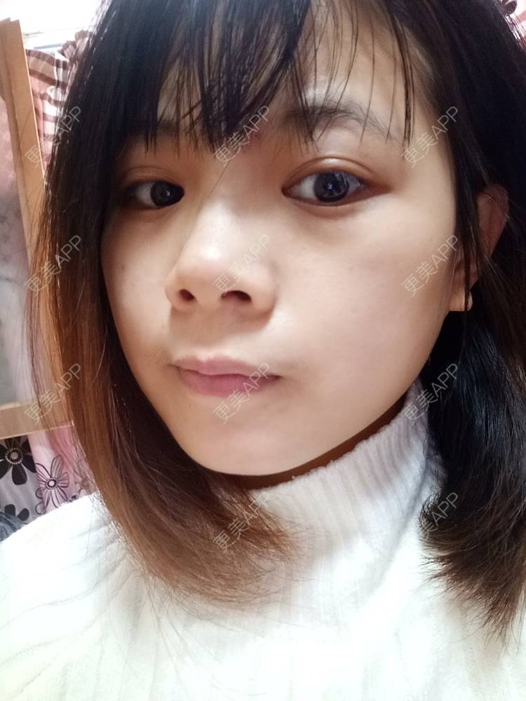 更美 - 更美用户2xAqCgwVY0的内切去眼袋经验 | 内切去眼袋 | 武汉