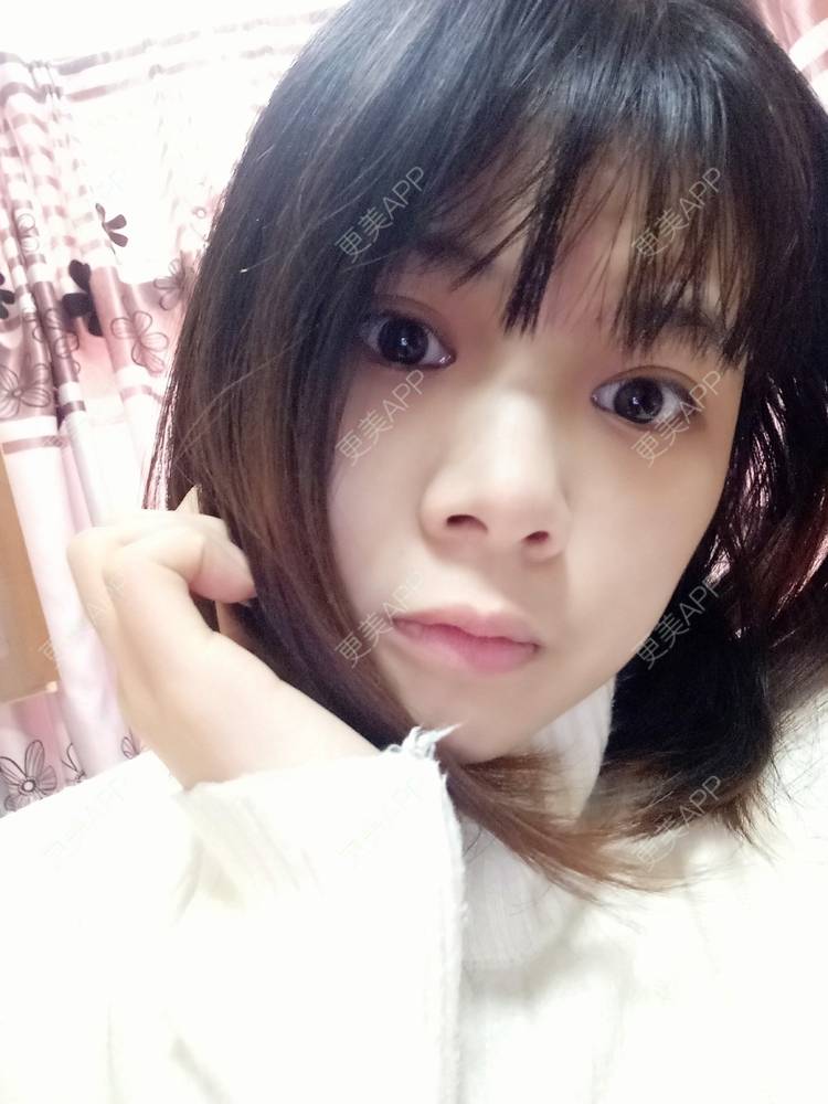 更美 - 更美用户2xAqCgwVY0的内切去眼袋经验 | 内切去眼袋 | 武汉