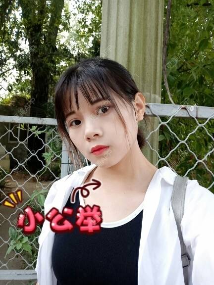更美 - 更美用户2xAqCgwVY0的内切去眼袋经验 | 内切去眼袋 | 武汉