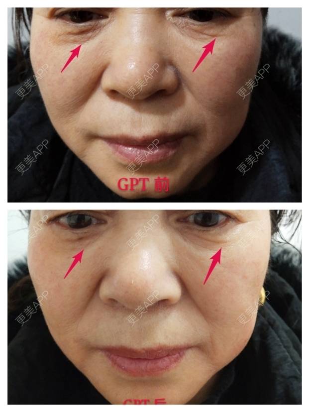 更美 - 努力=幸运的胶原蛋白改善法令纹经验 | 视频日记 | 胶原蛋白改善法令纹 | 池州