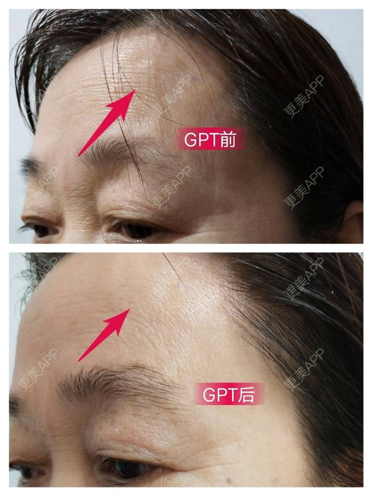 更美 - 努力=幸运的胶原蛋白改善法令纹经验 | 视频日记 | 胶原蛋白改善法令纹 | 池州
