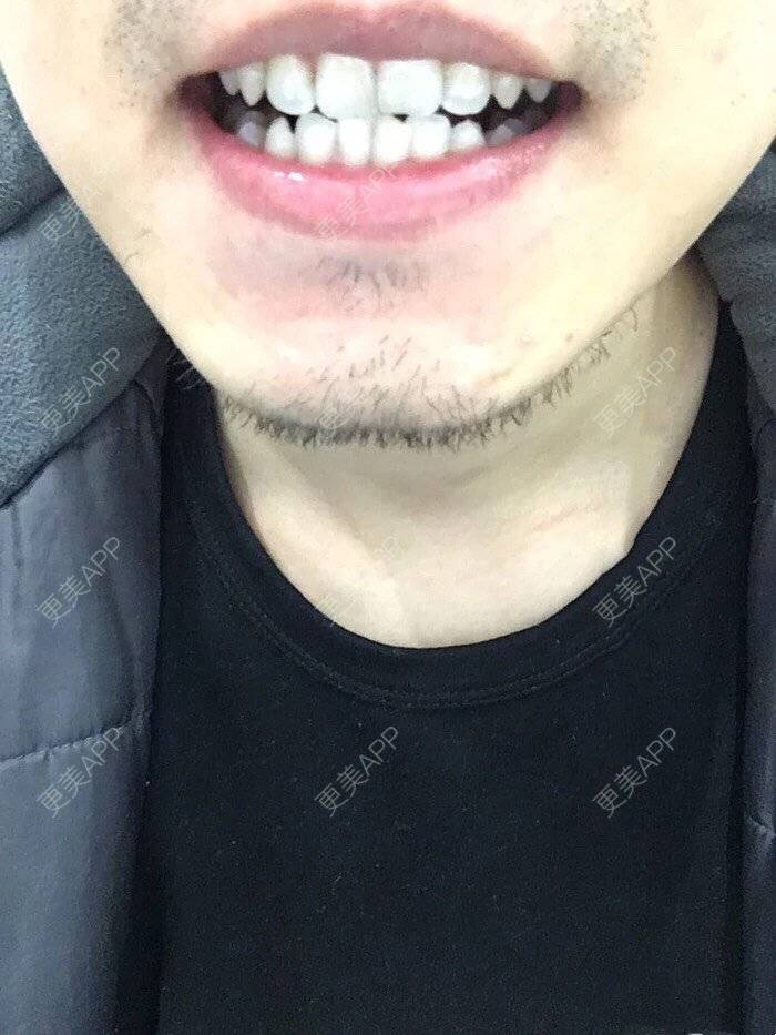 更美 - 更美用户4qLnFsalO6的超声波洗牙经验 | 超声波洗牙 | 洗牙套餐 | 成都