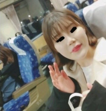 颧骨内推
