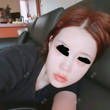 颧骨内推