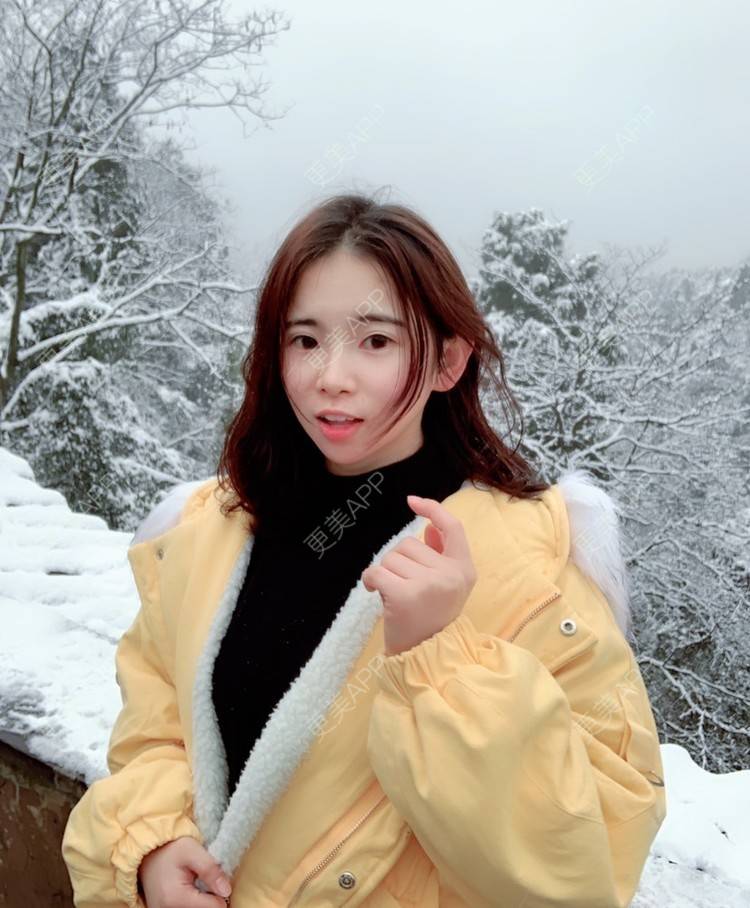 更美 - 九 五.的全切双眼皮经验 | 更美研究所 | 注射美白 | 水光项目 | 全切双眼皮 | 内切去眼袋 | 自体脂肪填充泪沟 | 视频日记