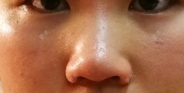 鼻翼缩小