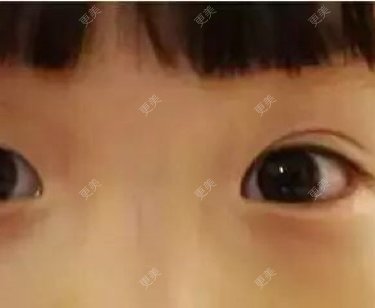 全切双眼皮