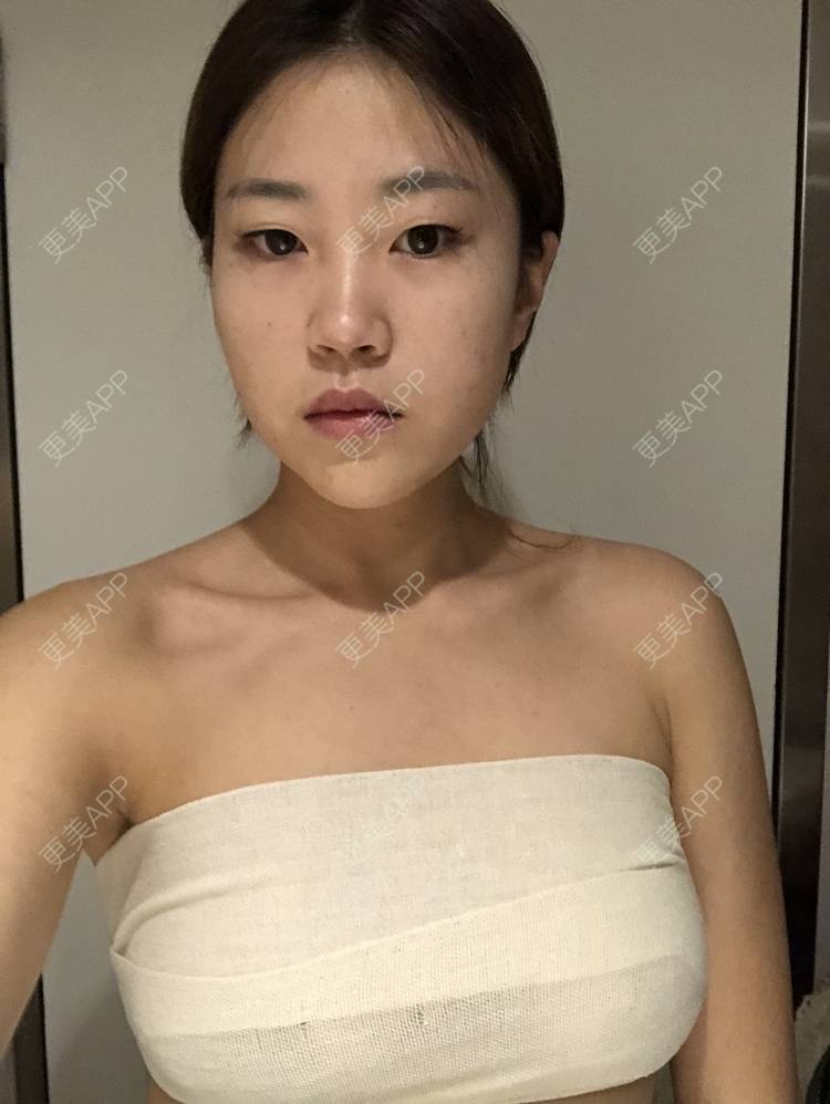 更美 - 爱茜茜雨露的假体隆胸经验 | 假体隆胸 | 重庆