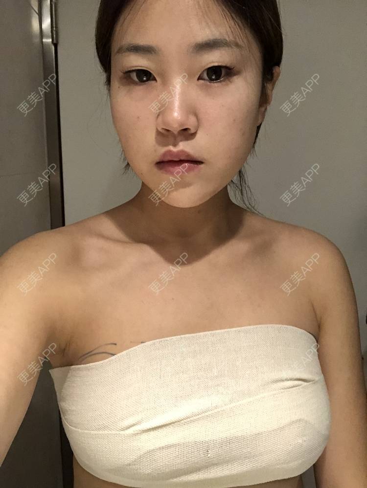 更美 - 爱茜茜雨露的假体隆胸经验 | 假体隆胸 | 重庆