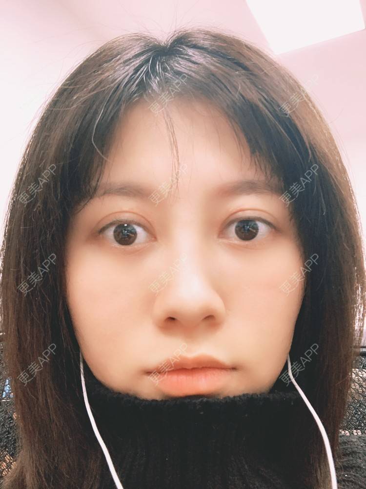 更美 - 更美用户qFi8xuX6UQ的激光去脂肪粒经验 | 激光去脂肪粒