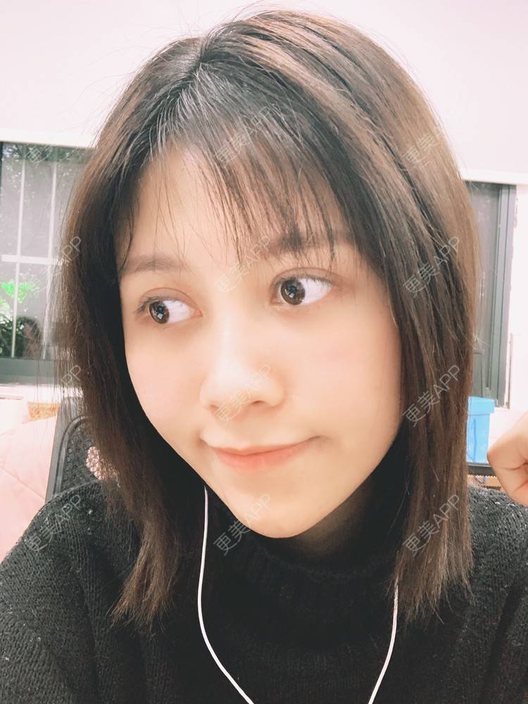 更美 - 更美用户qFi8xuX6UQ的激光去脂肪粒经验 | 激光去脂肪粒