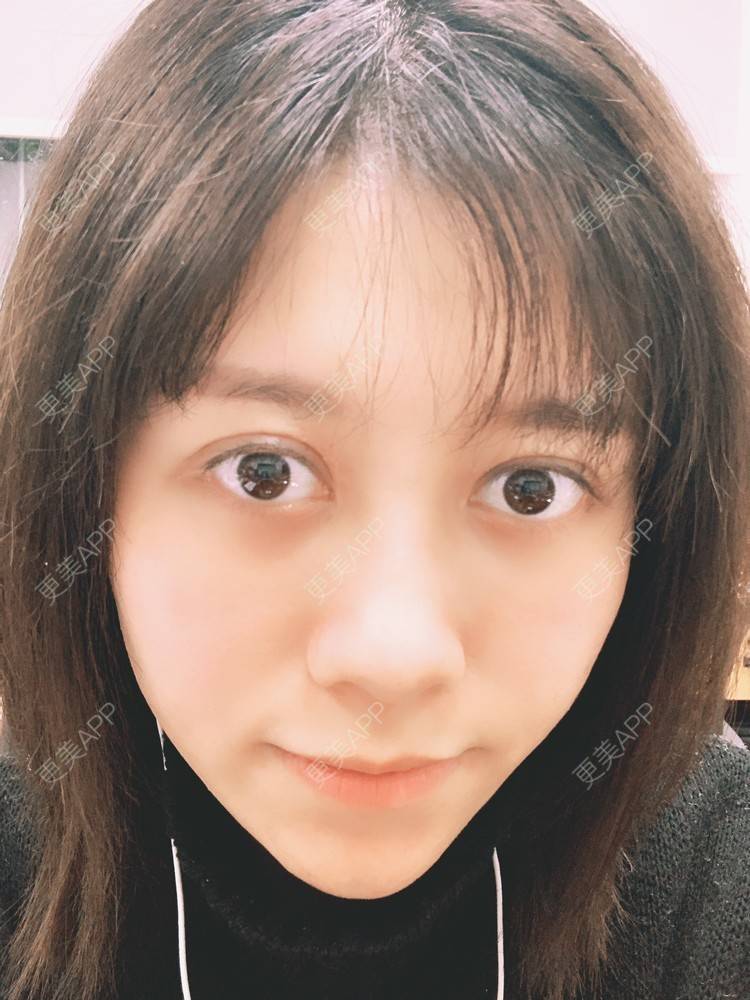 更美 - 更美用户qFi8xuX6UQ的激光去脂肪粒经验 | 激光去脂肪粒