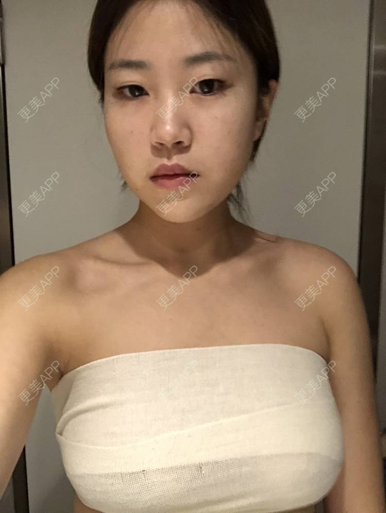 更美 - 爱茜茜雨露的假体隆胸经验 | 假体隆胸 | 重庆