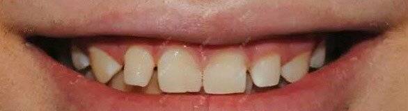 更美 - 更美用户opiCAPt1I2的牙齿瓷贴面经验 | 牙齿瓷贴面 | 成都