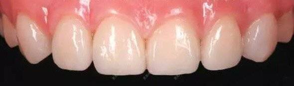 更美 - 更美用户opiCAPt1I2的牙齿瓷贴面经验 | 牙齿瓷贴面 | 成都