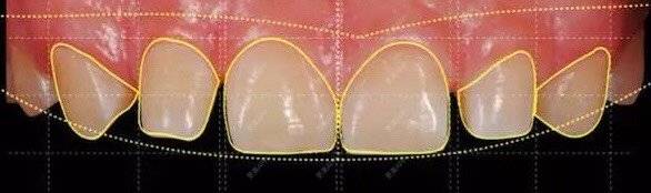 更美 - 更美用户opiCAPt1I2的牙齿瓷贴面经验 | 牙齿瓷贴面 | 成都